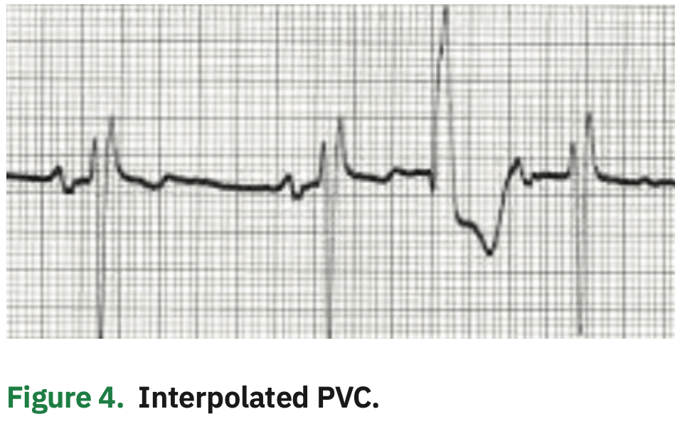 Compensatory Versus Pauses